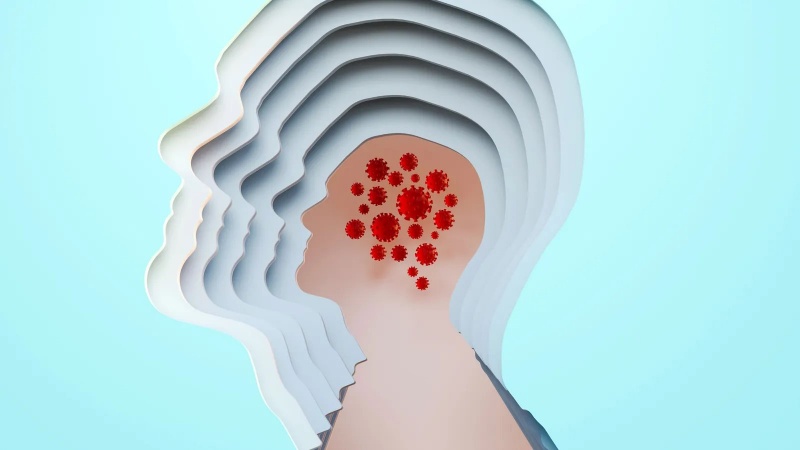 Alzheimer's disease