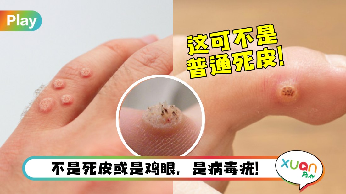 about-wart.jpg