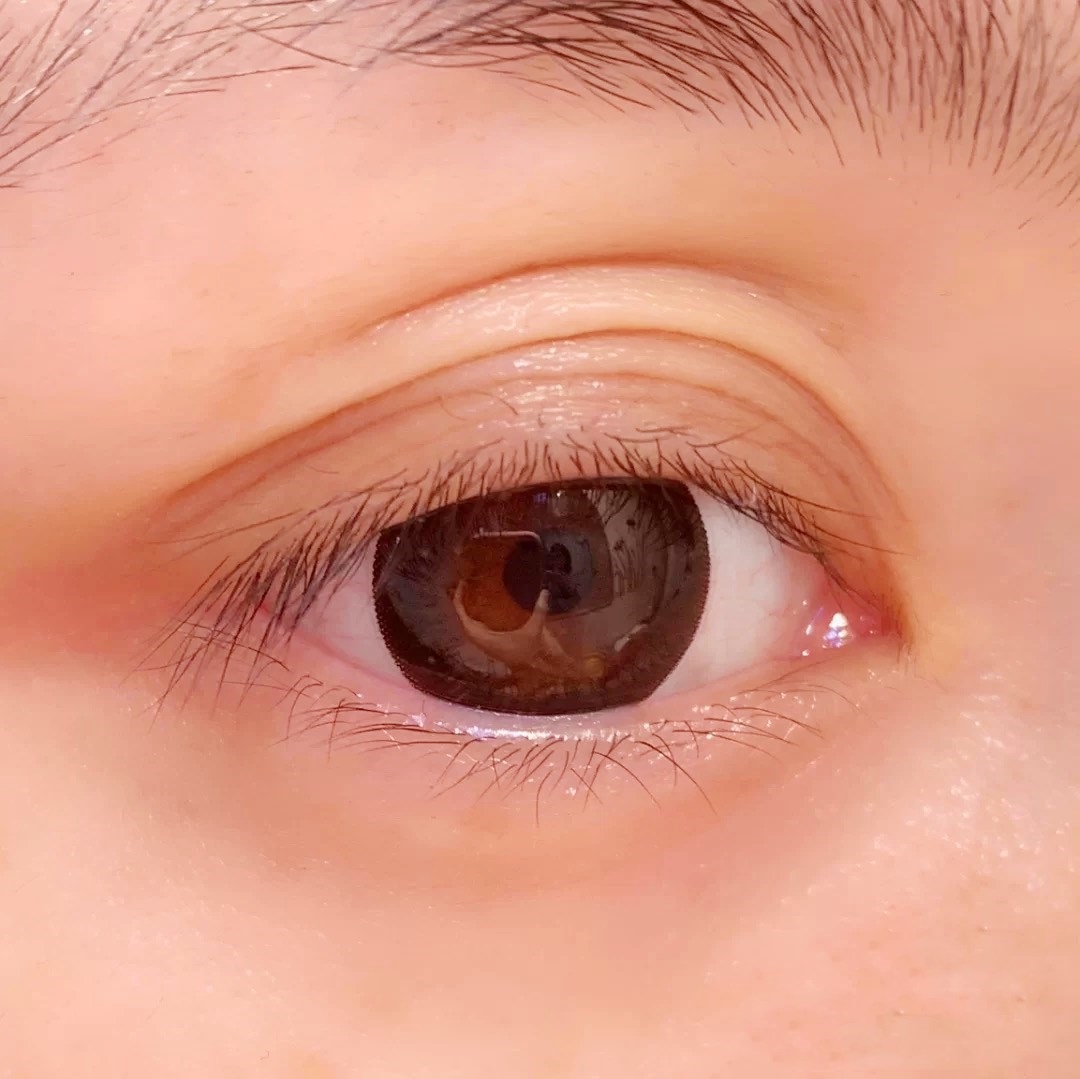 多层眼皮