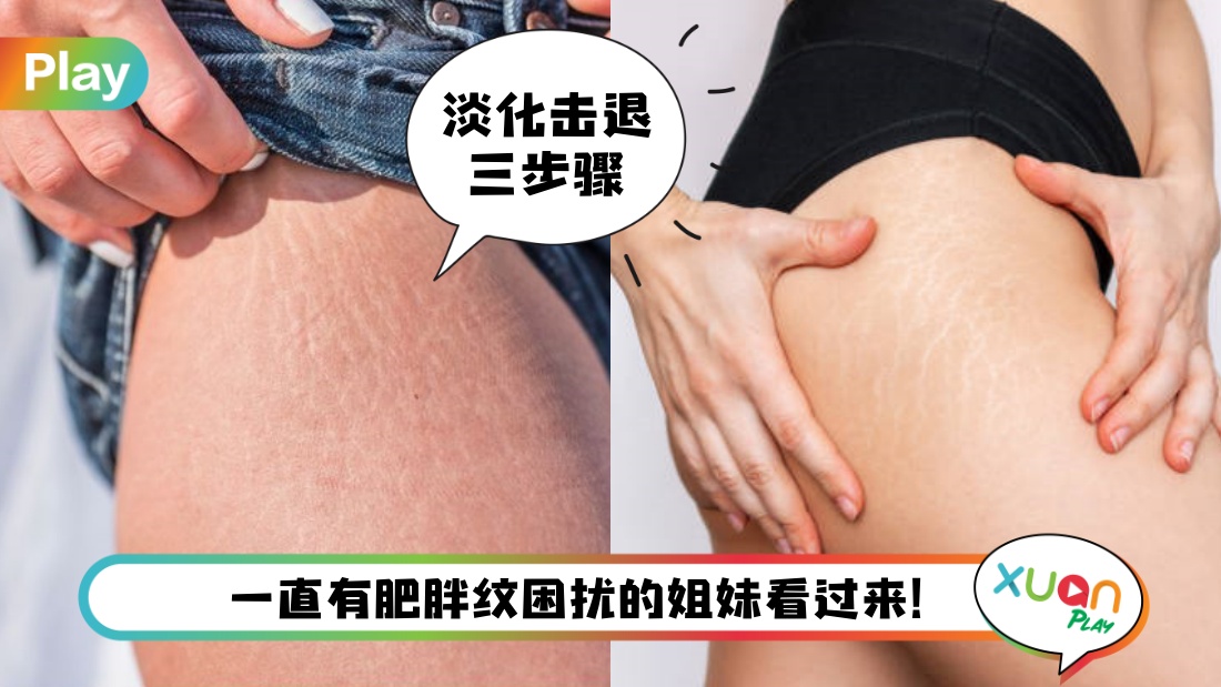 stretch-mark-tips.jpg