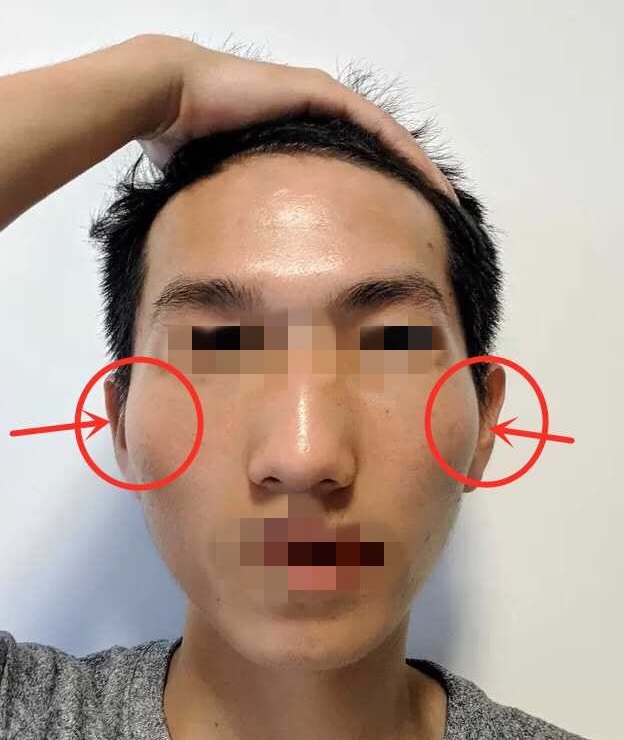大颧骨
