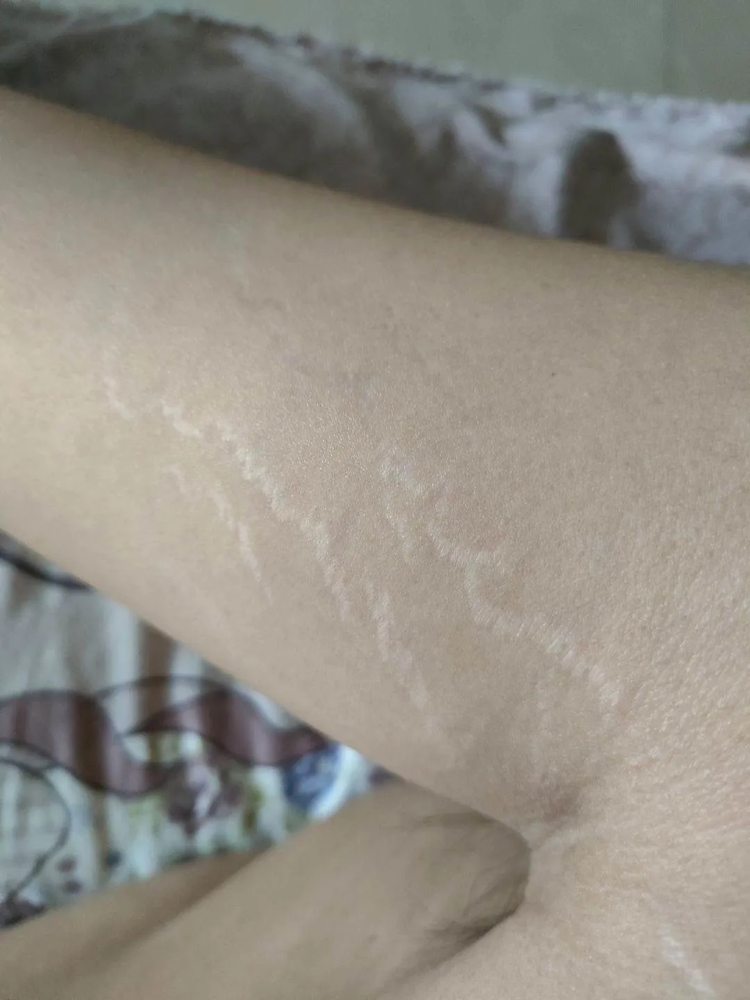 手臂上的肥胖纹