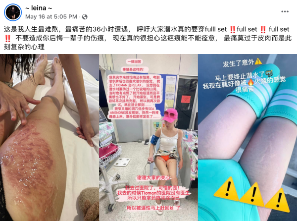 大马美女DJ潜水遭海葵蛰伤